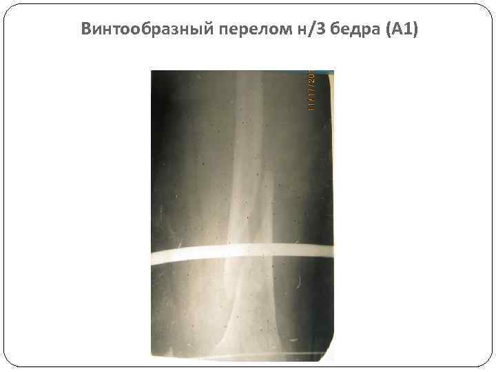 Винтообразный перелом н/3 бедра (А 1) 