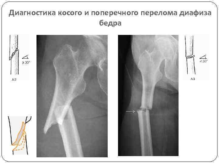 Подвертельный перелом бедра фото