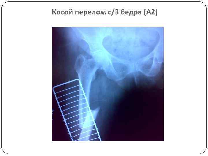 Косой перелом с/3 бедра (А 2) 
