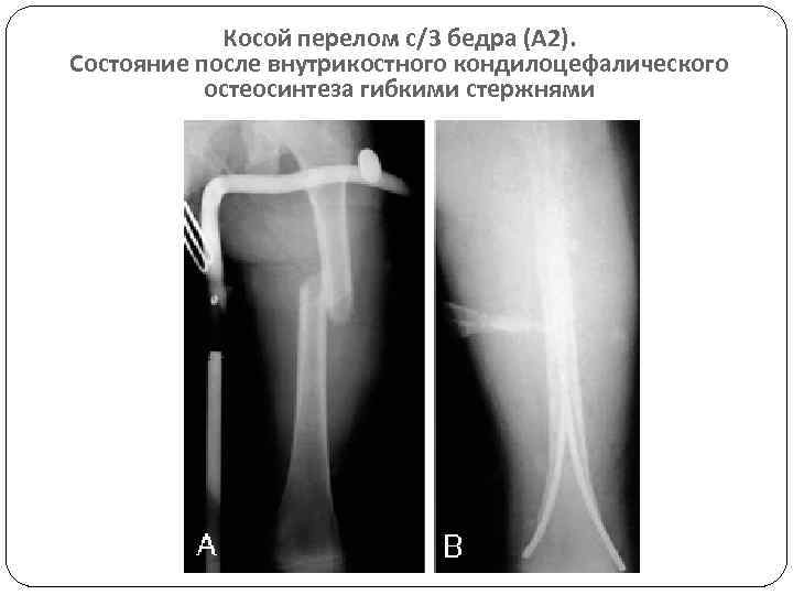 Остеосинтез бедра фото