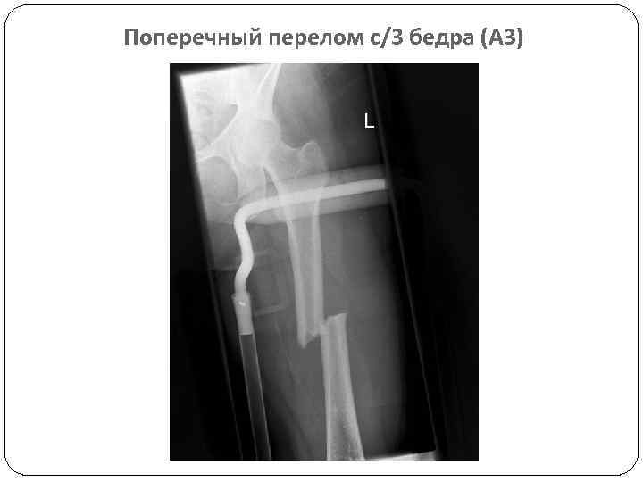 Поперечный перелом с/3 бедра (А 3) 