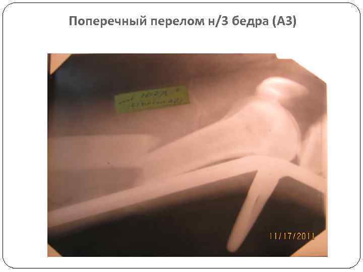 Поперечный перелом н/3 бедра (А 3) 