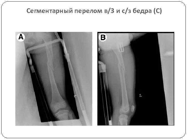 Карта вызова смп перелом бедра