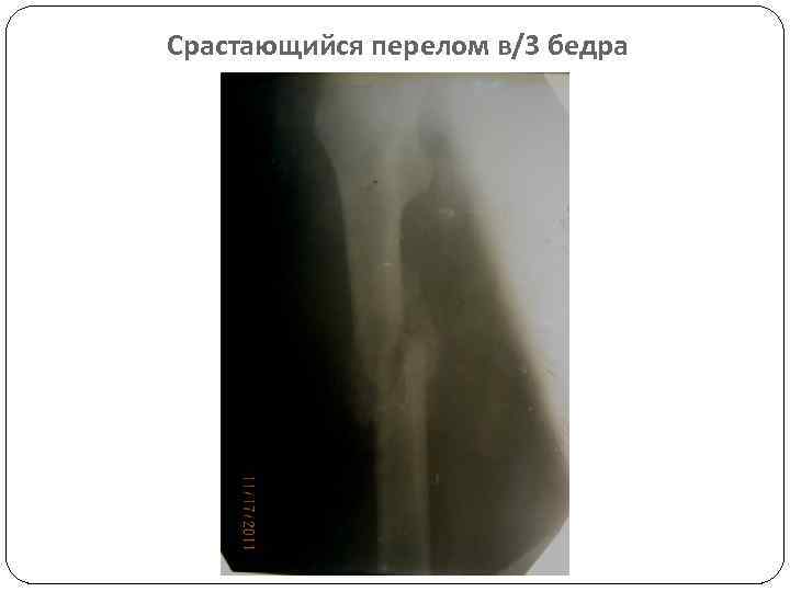 Срастающийся перелом в/3 бедра 