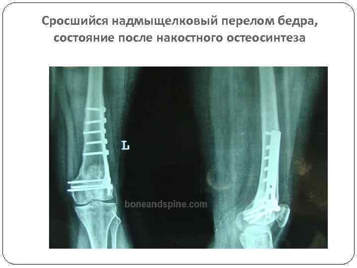 Сросшийся надмыщелковый перелом бедра, состояние после накостного остеосинтеза 