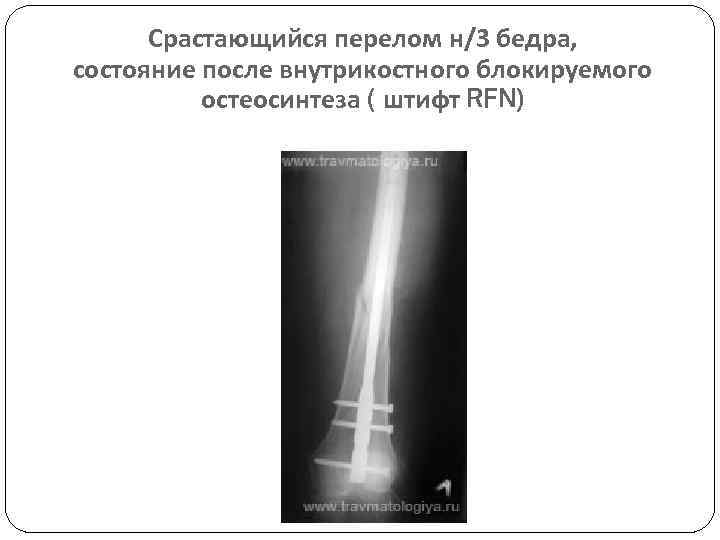 Срастающийся перелом н/3 бедра, состояние после внутрикостного блокируемого остеосинтеза ( штифт RFN) 