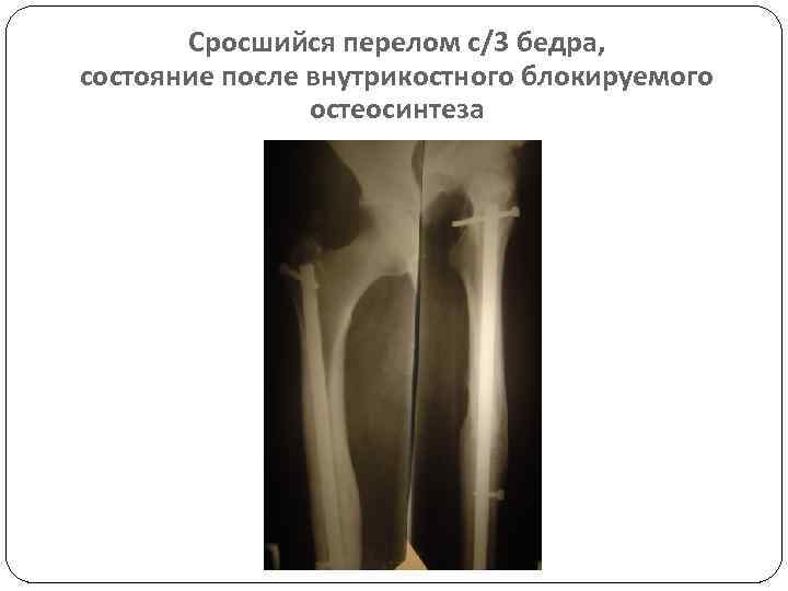 Карта вызова смп перелом бедра