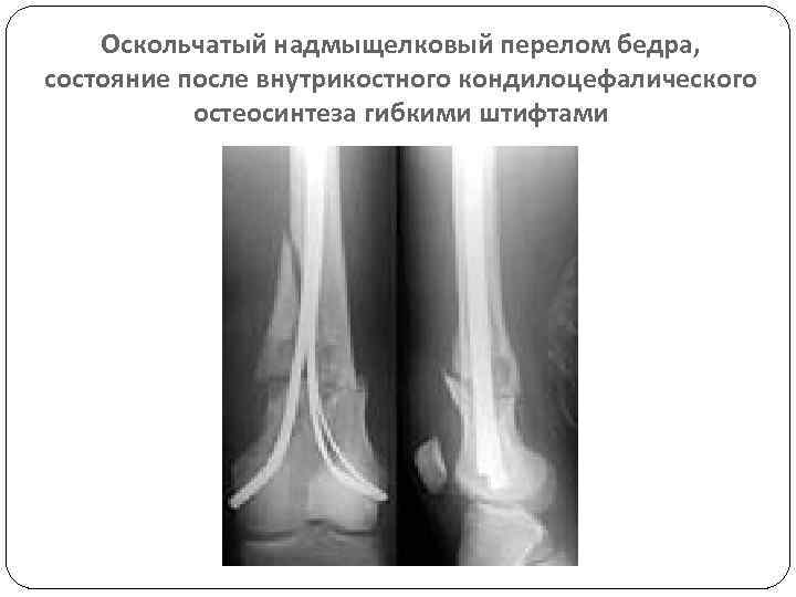 Оскольчатый надмыщелковый перелом бедра, состояние после внутрикостного кондилоцефалического остеосинтеза гибкими штифтами 