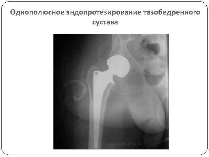 Однополюсное эндопротезирование тазобедренного сустава 