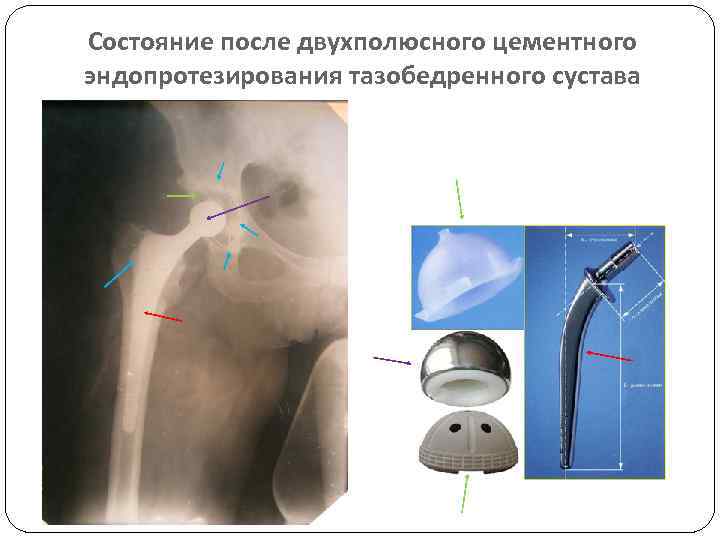 Состояние после двухполюсного цементного эндопротезирования тазобедренного сустава 