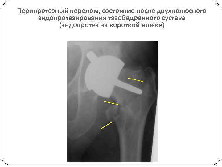 Перипротезный перелом, состояние после двухполюсного эндопротезирования тазобедренного сустава (эндопротез на короткой ножке) 