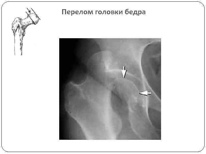 Перелом шейки бедра фото