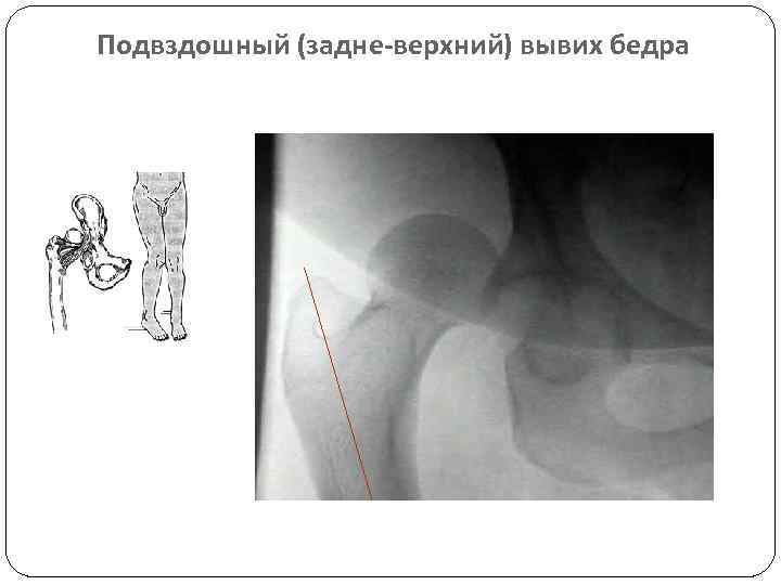 Вывих бедра карта вызова