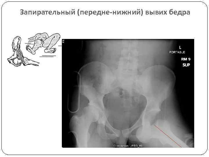 Вывих бедра карта вызова смп