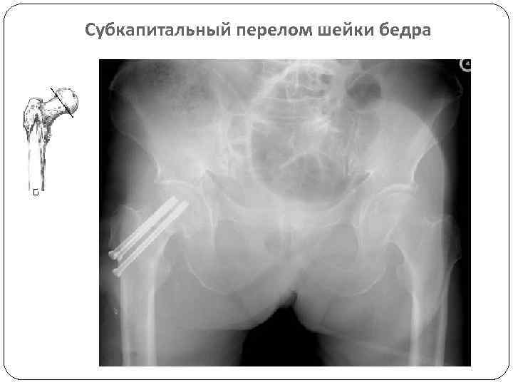 Субкапитальный перелом шейки бедра 