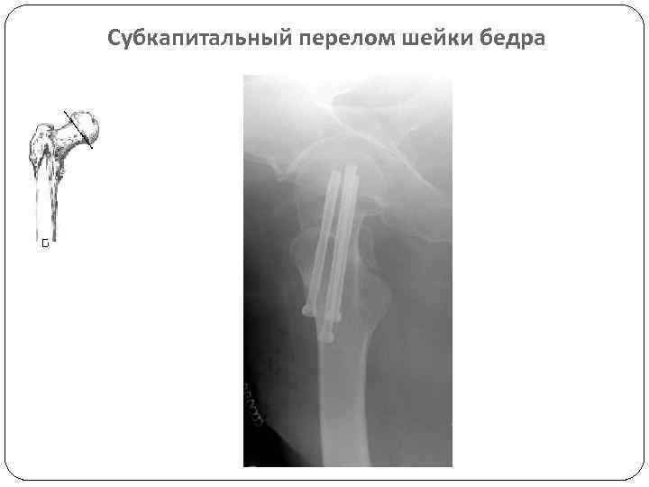 Субкапитальный перелом шейки бедра 