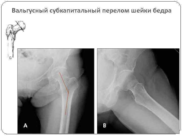 Вальгусный субкапитальный перелом шейки бедра 