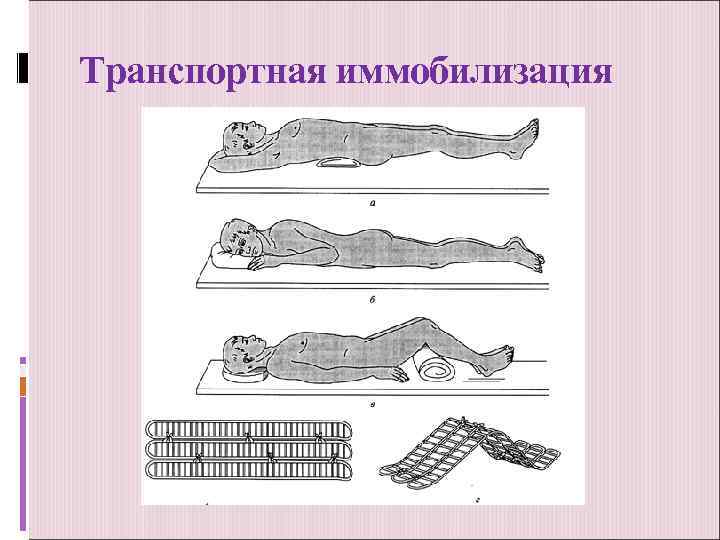 Транспортная иммобилизация 