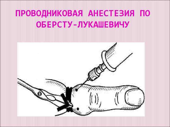 ПРОВОДНИКОВАЯ АНЕСТЕЗИЯ ПО ОБЕРСТУ-ЛУКАШЕВИЧУ 