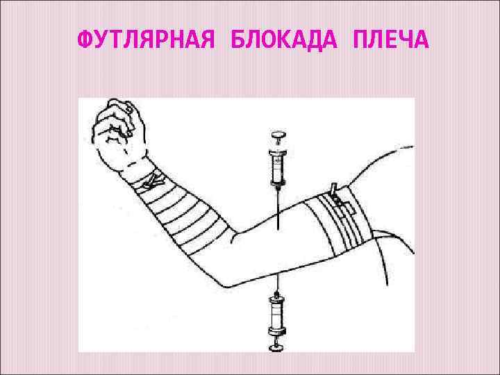 ФУТЛЯРНАЯ БЛОКАДА ПЛЕЧА 