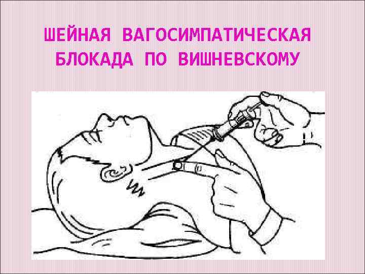 ШЕЙНАЯ ВАГОСИМПАТИЧЕСКАЯ БЛОКАДА ПО ВИШНЕВСКОМУ 