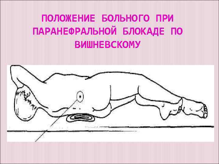 ПОЛОЖЕНИЕ БОЛЬНОГО ПРИ ПАРАНЕФРАЛЬНОЙ БЛОКАДЕ ПО ВИШНЕВСКОМУ 
