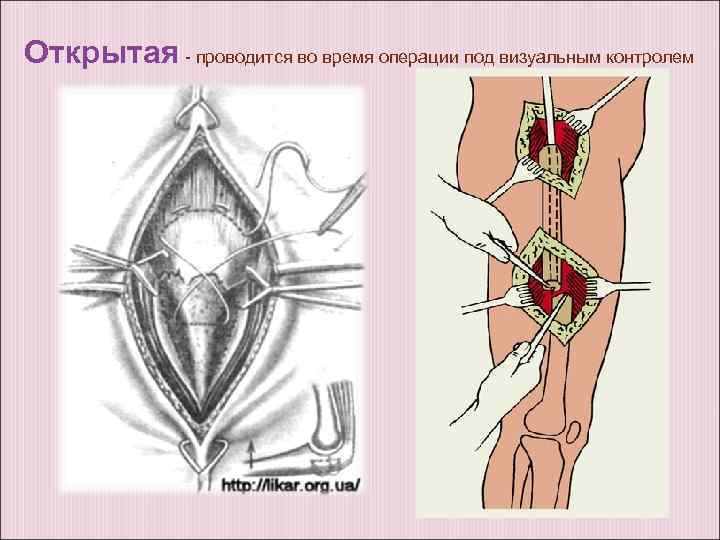 Открытая - проводится во время операции под визуальным контролем 