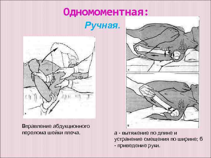 Одномоментная: Ручная. Вправление абдукционного перелома шейки плеча. а - вытяжение по длине и устранение