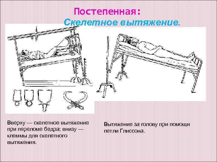 Постепенная: Скелетное вытяжение. Вверху — скелетное вытяжение при переломе бедра; внизу — клеммы для
