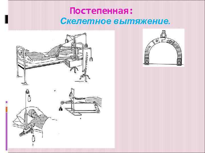 Постепенная: Скелетное вытяжение. 
