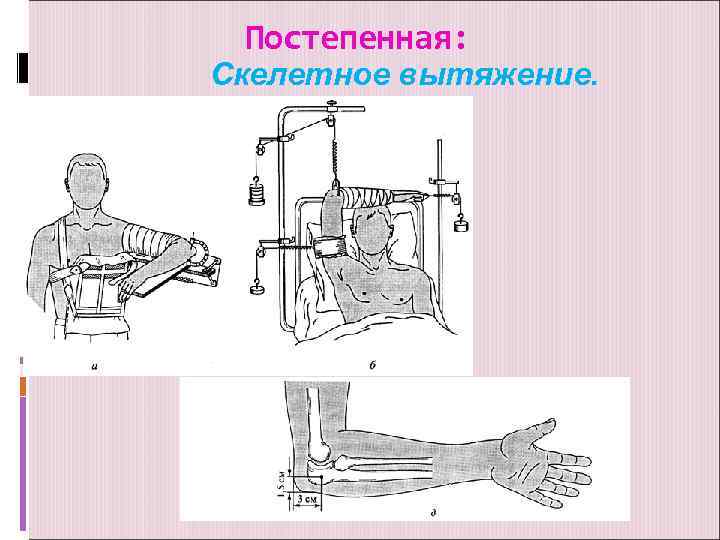 Постепенная: Скелетное вытяжение. 