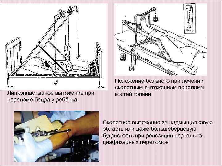 Липкопластырное вытяжение при переломе бедра у ребёнка. Положение больного при лечении скелетным вытяжением перелома