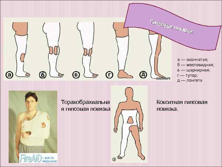 Гипсо вые п овязк и. а — окончатая; б — мостовидная; в — шарнирная;