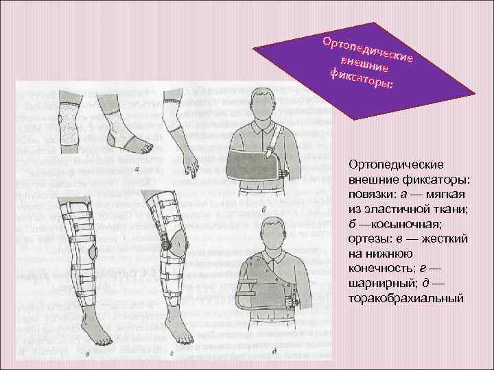 Ортоп едиче внешн ские фикса ие торы: Ортопедические внешние фиксаторы: повязки: а — мягкая