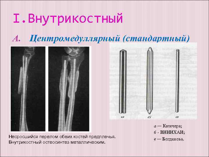 I. Внутрикостный A. Центромедуллярный (стандартный) Несросшийся перелом обеих костей предплечья. Внутрикостный остеосинтез металлическим. а