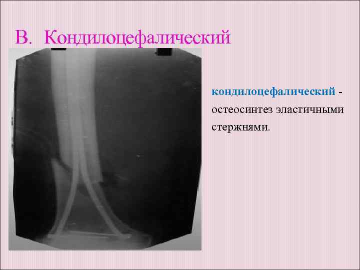B. Кондилоцефалический кондилоцефалический остеосинтез эластичными стержнями. 