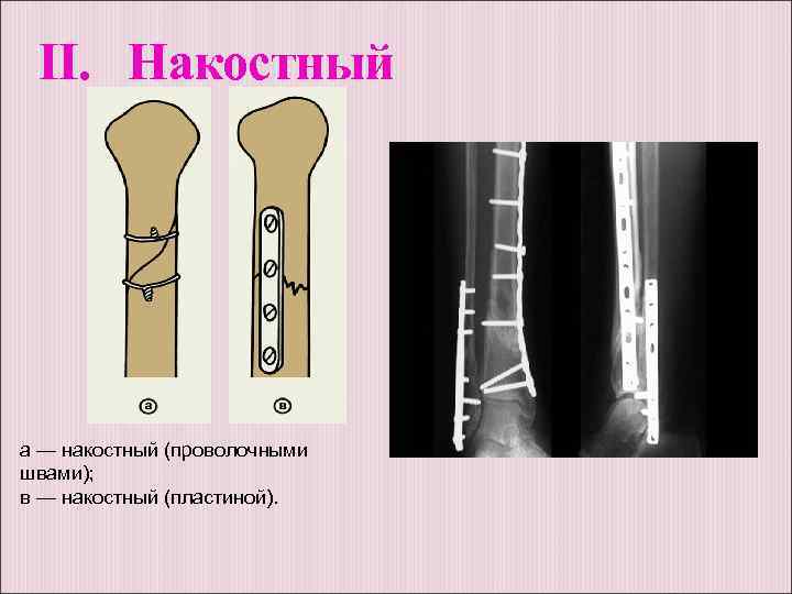 II. Накостный а — накостный (проволочными швами); в — накостный (пластиной). 