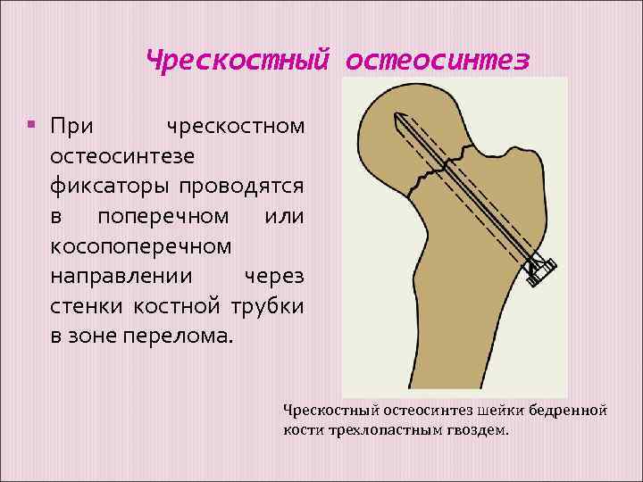 Чрескостный остеосинтез При чрескостном остеосинтезе фиксаторы проводятся в поперечном или косопоперечном направлении через стенки