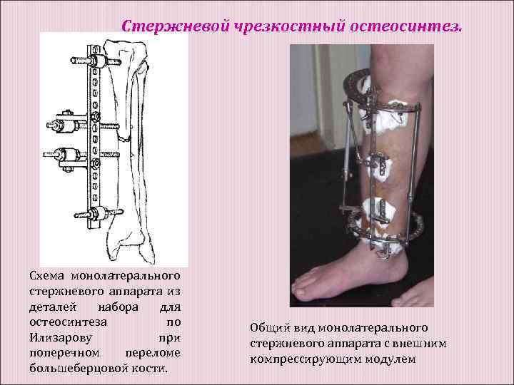 Стержневой чрезкостный остеосинтез. Схема монолатерального стержневого аппарата из деталей набора для остеосинтеза по Илизарову