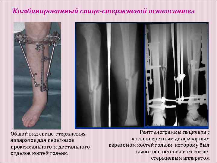Комбинированный спице-стержневой остеосинтез Общий вид спице-стержневых аппаратов для переломов проксимального и дистального отделов костей