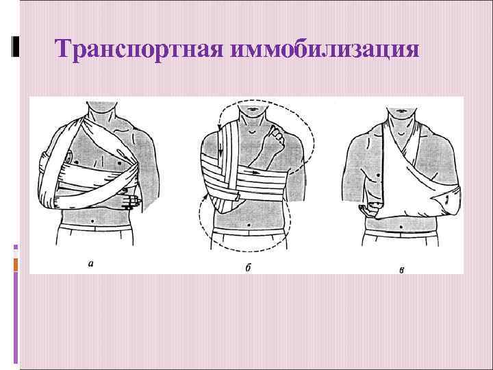 Транспортная иммобилизация картинки