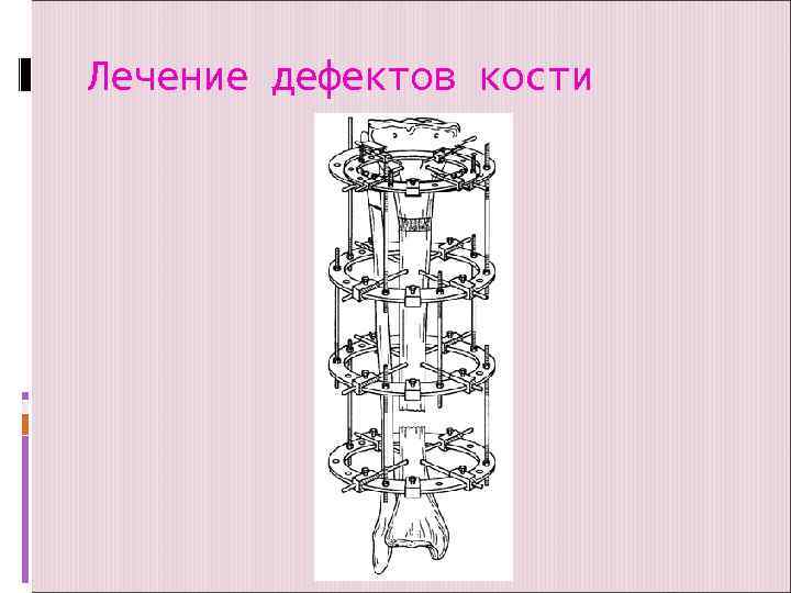 Лечение дефектов кости 