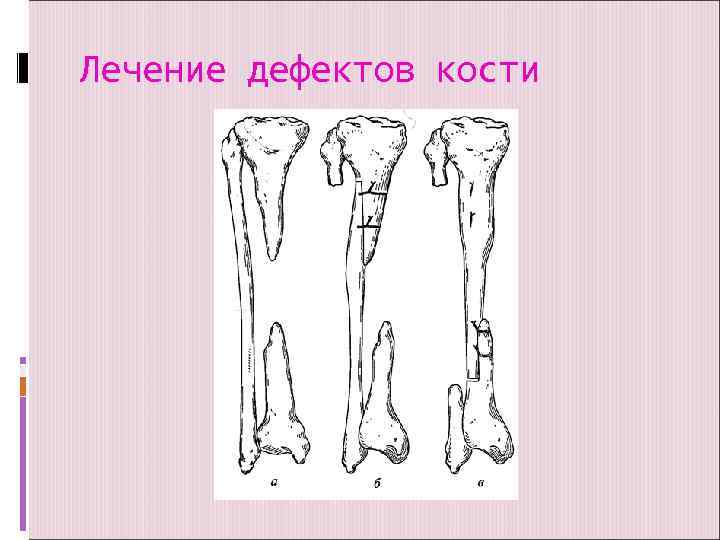 Лечение дефектов кости 
