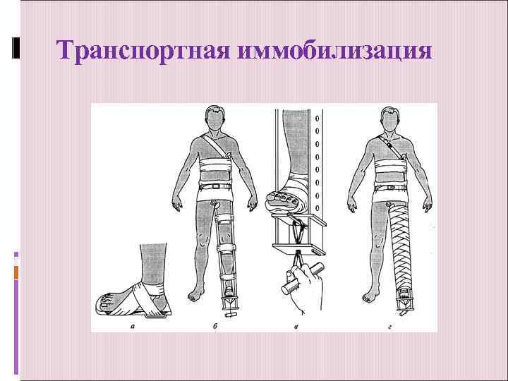 Транспортная иммобилизация 