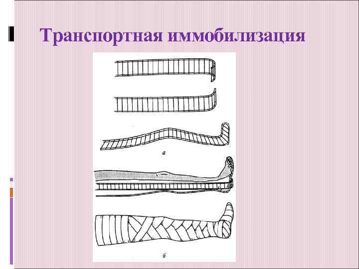Транспортная иммобилизация 