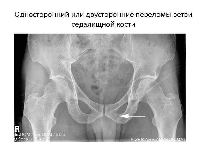 Односторонний или двусторонние переломы ветви седалищной кости 