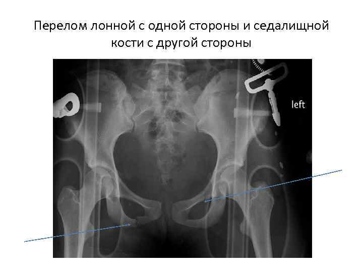 Перелом лонной с одной стороны и седалищной кости с другой стороны 