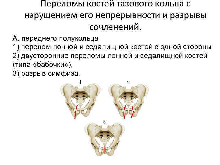 Переломы костей тазового кольца с нарушением его непрерывности и разрывы сочленений. А. переднего полукольца