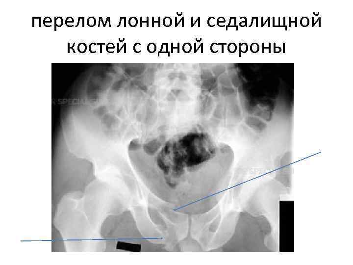 перелом лонной и седалищной костей с одной стороны 