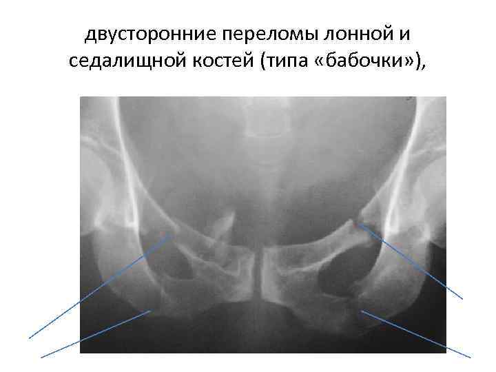 двусторонние переломы лонной и седалищной костей (типа «бабочки» ), 